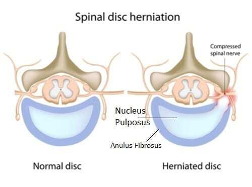 An image depicting the anatomy of a disc