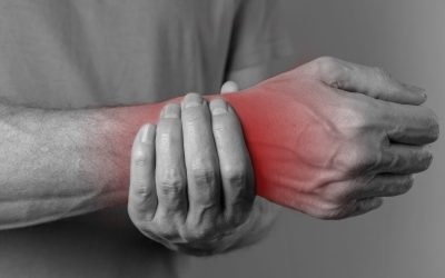 How to Manage a Colles Fracture